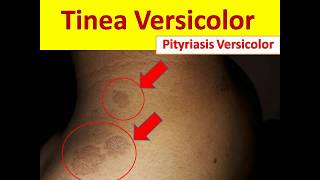 Tinea Versicolor in Young People  Pityriasis Versicolor [upl. by Ayila]