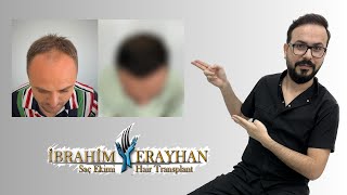 Saç Ekimi ile Doğal Ön Hat Tasarımı  Natural Front Line Design with Hair Transplantation [upl. by Stent54]