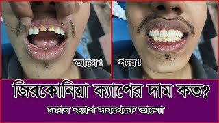 Zirconia Crown Price in Bangladesh  জিরকোনিয়া ক্যাপের দাম  কোন ক্যাপ ভালো ।। স্বাস্থ্য সেবা [upl. by Zelma791]