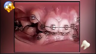 2 Years Of Braces In 20 Seconds Braces Timelapse Shorts [upl. by Chevalier]