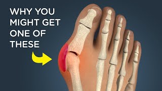 Bunions What Causes Them and How Theyre Removed [upl. by Corene343]