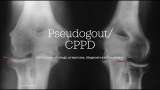 Pseudogout  CPPD Calcium pyrophosphate deposition disease Essential medicine [upl. by Xonk]