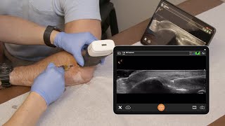 Lateral Epicondyle Injection  Ultrasound Scanning Technique [upl. by Buffy]