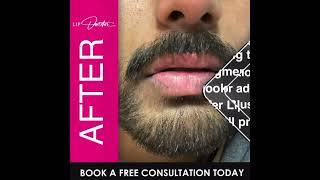 Stunning Lip Brightening Transformation  Pico Laser amp Lip Blush Before and After at Lip Doctor [upl. by Lynd]