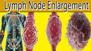 Lymph Node Enlargement  7 Most common causes [upl. by Asserat]