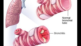 Bronchitis PEV [upl. by Durst]