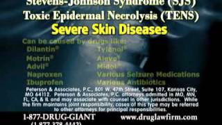 Dilantin Lawsuit SJS Side Effects with Dilantin [upl. by Avlem]