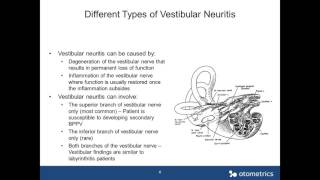 Otometrics Webinar  Vestibular Neuritis How to Identify Different Types [upl. by Dahsraf]