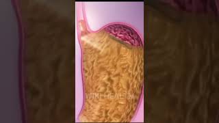 Acid Reflux Wikihealth shorts short shortvideo shortvideo [upl. by Enitsyrk]