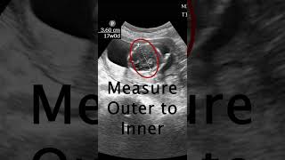 How to measure a Biparietal Diameter POCUS Ultrasound emergencymedicine obgyn [upl. by Milburr]