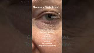 Myokymia or eyelid twitch youtubeshorts science medicalstudent shortsfeed biology [upl. by Ydaf]