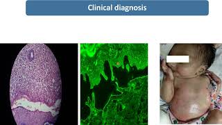 Epidermolysis Bullosa  Spot Diagnosis  9  Pediatrics [upl. by Ordnas]