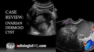 Case Review Ultrasound of Ovarian Dermoid Cyst [upl. by Eed]