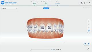 Ortho Simulation Aoralscan 3 SHining3d Simulador de tratamiento de alineadores [upl. by Haig]