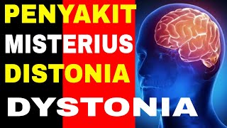 CARA MENGATASI PENYAKIT DISTONIADYSTONIA [upl. by Ronal]