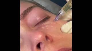 MicronJetTM in Action Intradermal Delivery of Aesthetic Product to the Preorbital Under Eye Area [upl. by Akeme]