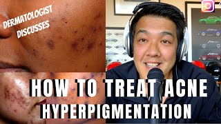 How to treat ACNE PIGMENTATION  PIH [upl. by Dianthe]