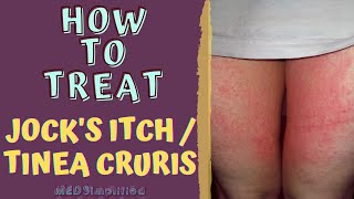 HOW TO TREAT JOCKS ITCH  TINEA CRURIS [upl. by Johnny25]