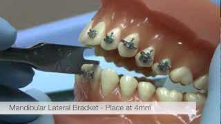 American Orthodontics Alexander LTS Brackets  Bracket Placement Video [upl. by Dimitry]