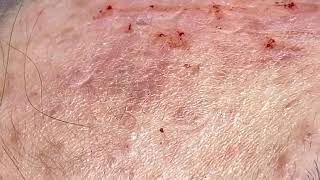 Poping zits around blackheads poping part 04 [upl. by Elly]