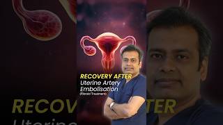 Recovery after Uterine Artery Embolisation  Recovery Time after Uterine Fibroid Embolization UFE [upl. by Anul980]