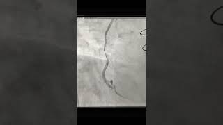 Angioplasty of SVG to PDA Graft with Embolic protection device in post CABG patient after 5 year [upl. by Dieter36]