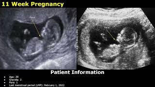 First Trimester Pregnancy Ultrasound Reporting  Obstetric USG Scan Reports  512 Weeks Fetal USG [upl. by Cleopatra]