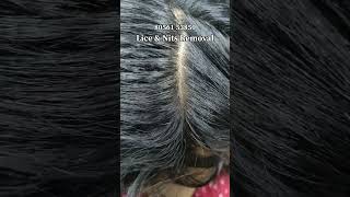 nits lice treatment 💯 result just 2 hrs Chennai hairheadliceheadlicetreatment [upl. by Dugan274]