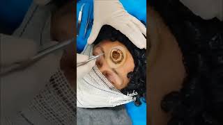 Botfly Maggot Removal spa doctor satisfying pimple removal [upl. by Gherardi]