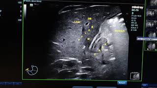 Hypertrophic Pyloric Stenosis HPS [upl. by Moir]