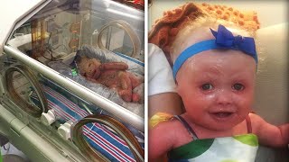 New York Babys Skin Cracked Minutes After Her Birth Due to Rare Condition [upl. by Aisila]