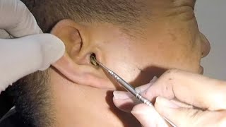 One Hard Earwax Removed form Mans Ear [upl. by Akemej]