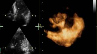 3D MITRAL REGURGITATION PROLAPSE P2 AND P3 [upl. by Baum745]