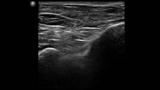 Ankle Ultrasound Tibiotalar Ankle Joint Injection [upl. by Felecia825]