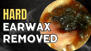 SOLID Hard Earwax Removed After Weeks [upl. by Wil]