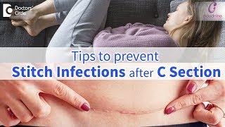 CSection Stitch InfectionsSigns Prevention amp Treatment  Immediate CareDrShashikala Hande of C9 [upl. by Luedtke2]