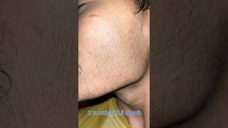 minoxidil minoxidil beard growth  2 month minoxidil beard  mintop [upl. by Poland]