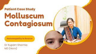 Successful Case Study of Molluscum Contagiosum Dr Rupam Sharma Homoeopathy [upl. by Odlabu]