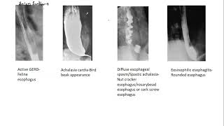 Barium studies  Esophagus  Achalasia Cardia  Bird beak appearance  High yield Medcampus [upl. by Finlay]