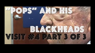 quotPopsquot and his blackhead extractions Visit 5 including skin biopsy [upl. by Aihsas]