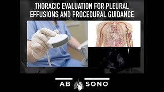 Thoracic evaluation for pleural effusions and procedural guidance [upl. by Axela]