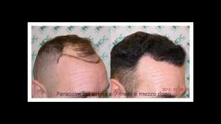 Trapianto di capelli FUE 3050 grafts [upl. by Yeloc]