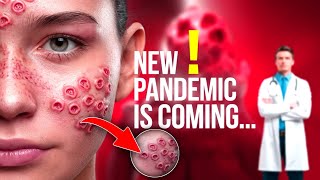 Monkey pox  New Pandemic Is Coming  M Pox Virus explained  M Pox Outbreak [upl. by Eeralav]