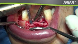 MegaGen MiNi implant placement  Clinical case video 1 [upl. by Snah]