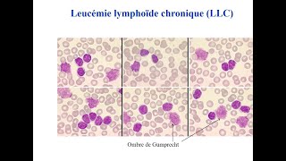 LLC  cours socle DES hématologie du 19 avril 2022 [upl. by Jarrell]