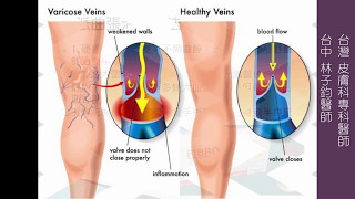 靜脈曲張的治療方式極緻美型·文心極緻皮膚科診所整形手術林子鈞醫師：靜脈曲張台中靜脈曲張硬化劑雷射治療注射治療 [upl. by Kasevich]
