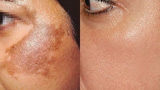 Remove Pigmentation In Just 10 Days  Top 3 Home Remedies To Remove Skin Pigmentation Permanently [upl. by Oiceladni]