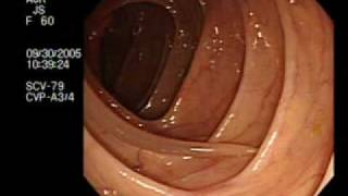 Colonoscopy Demonstrating a Moving Worm  NEJM [upl. by Oirram]