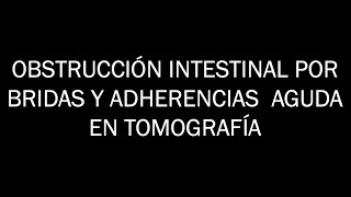 OBSTRUCCIÓN INTESTINAL POR BRIDAS Y ADHERENCIAS POR TOMOGRAFÍA [upl. by Snej]