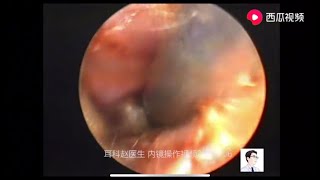 Treatment of cerumen embolism in children，10minutes [upl. by Gowrie]